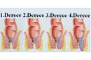 4 Derece Hemoroid Belirtileri ve Tedavisi 4 Derece Hemoroid Belirtileri ve Tedavisi