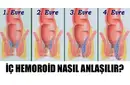 İç Hemoroid Belirtileri ve Tedavisi İç Hemoroid Belirtileri ve Tedavisi
