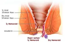 Hemoroid Memesi Nasıl Geçer? Hemoroid Memesi Nasıl Geçer?