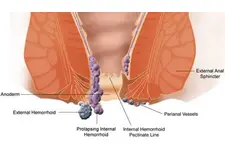 Hemoroid Sıcak Suyun Etkisi Hemoroid Sıcak Suyun Etkisi