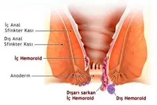 Makatta Hemoroid Belirtileri ve Tedavisi Makatta Hemoroid Belirtileri ve Tedavisi