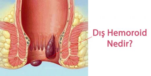 Dış Hemoroid Belirtileri ve Tedavisi