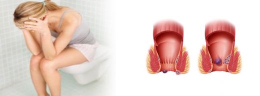 Dış Hemoroid Ameliyatı Riskleri ve Sonrası