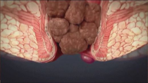 Dış Hemoroid İlaçları Kullanımı ve Faydaları Nelerdir?