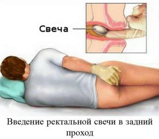 Hemoroid Başlangıcı Belirtileri ve Tedavisi