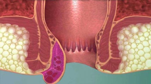 Hemoroid Hastalığı Belirtileri ve Tedavisi