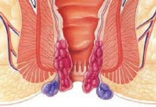 Hemoroid Kaşıntı Tedavi Şekli