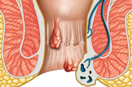 Hemoroid Kremi Kullanımı ve Faydaları Nelerdir?