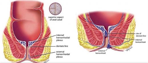 Hemoroid Nedir? Belirtileri ve Tedavisi