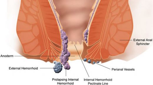 Hemoroid Scak Su