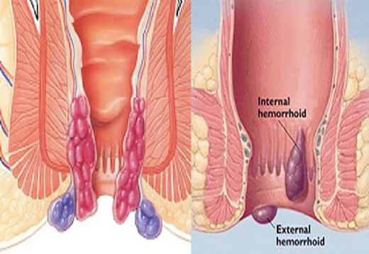 Hemoroid ilii Nasl ner