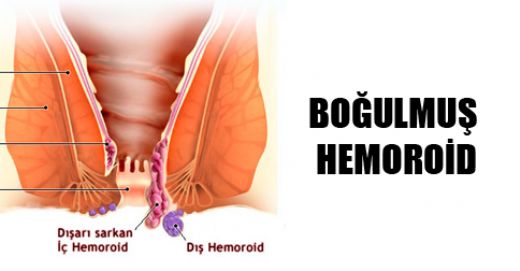 Tromboze Hemoroid