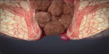 Hemoroid Kanaması, Belirtileri ve Tedavisi Hemoroid Kanaması