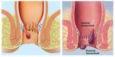 Hemoroid Yanma