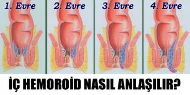 İç Hemoroid, Belirtileri ve Tedavisi İç Hemoroid